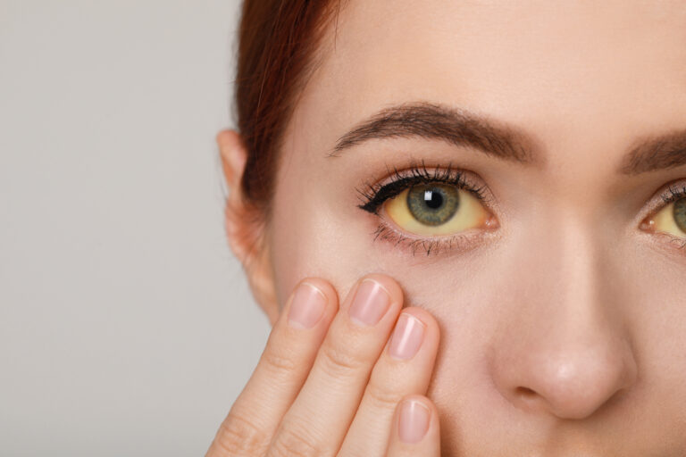 Woman with jaundice eye